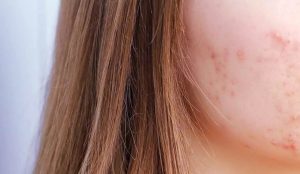 درمان قطعی جای جوش عمیق