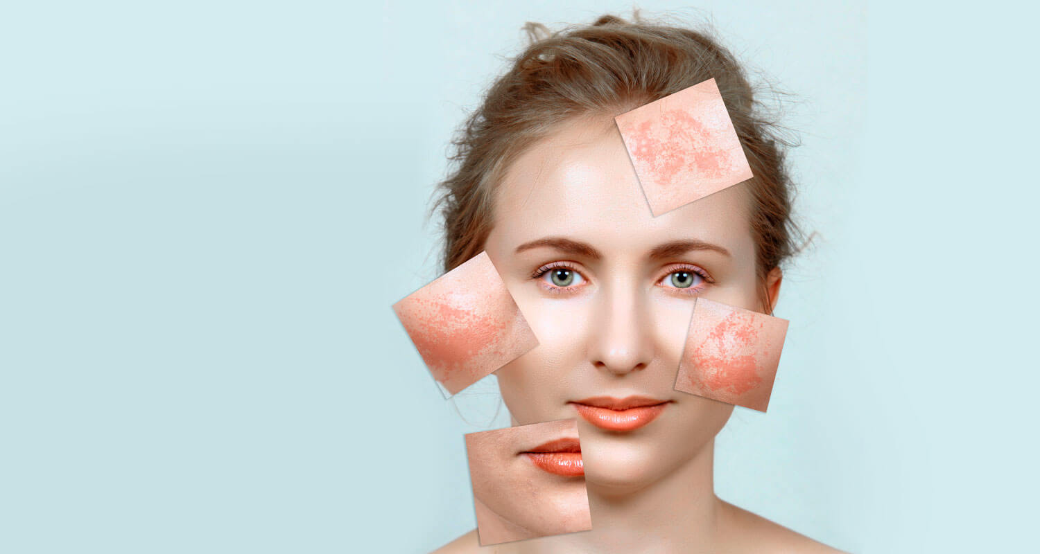 درمان لک صورت بعد از زایمان